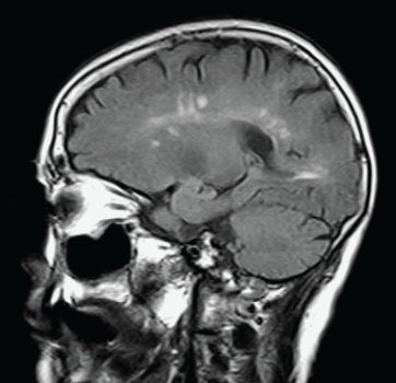   This sagittal T2 FLAIR MRI is consistent with: A)  MS. B)  ischemic stroke. C)  primary brain tumor. D)  pituitary adenoma.