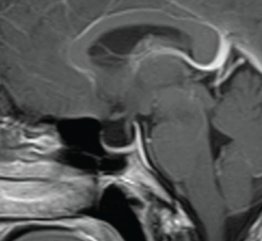   This sagittal contrast-enhanced T1 MRI shows a patient with: A)  visual field defects. B)  chronic headache and papilledema. C)  lower extremity weakness. D)  facial paresthesias.