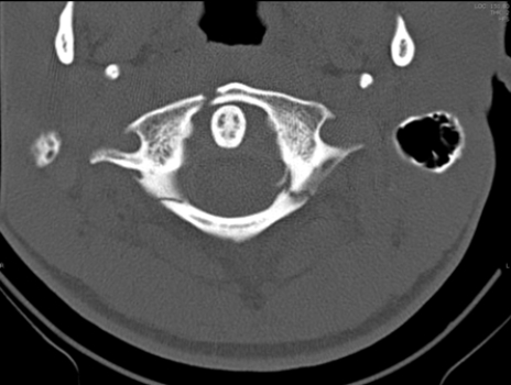   The image of this patient shows that the patient has what type of injury? A)  Hangman's fracture B)  Jefferson Burst fracture C)  Herniated C2 disk D)  C7 vertebral arch fracture
