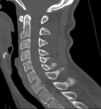   The patient in this image has which of the following? A)  A fractured arch at C1 B)  A fractured hyoid bone C)  A vertebral body compression fracture D)  A spinal metastatic disease