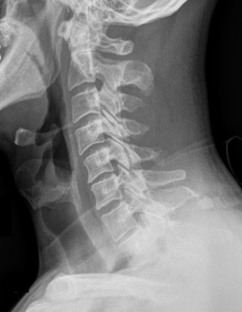   Which type of fracture(s)  does the image indicate? A)  Chance fracture B)  Clay-shoveler's fracture C)  Hangman's fracture D)  Cervical facet fractures