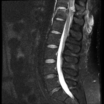   This image shows that the patient has which of the following? A)  Severe dehydration of the vertebral disks B)  Transected spinal cord C)  Spinal cord tumor D)  Cerebrospinal fluid (CSF)  infection