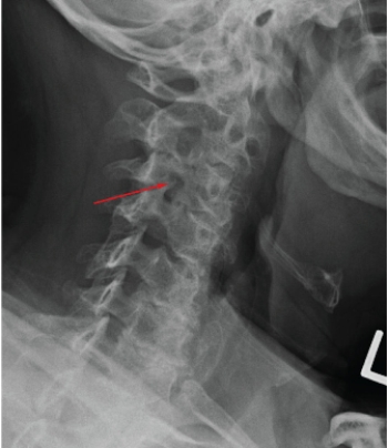   The arrow in the above image indicates: A)  a pars interarticularis defect. B)  a Chance fracture. C)  an arthritic facet joint marginal osteophyte. D)  a calcified herniated disk.