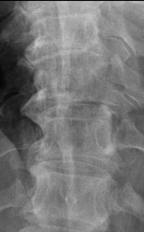   This image likely shows a patient with: A)  lytic bone disease. B)  scoliosis. C)  vertebral body compression fracture. D)  degenerative disk disease.