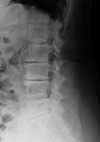  The above image depicts a patient with: A)  spondylolisthesis. B)  DISH. C)  lytic bone disease. D)  degenerative disk disease.