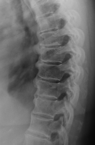   The above image depicts a patient with: A)  degenerative disk disease. B)  DISH. C)  lytic bone disease. D)  facet joint osteoarthritis.