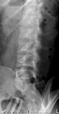   Which defect is portrayed in the image of this patient? A)  An L2 pars defect B)  An L3 pars defect C)  An L4 pars defect D)  An L5 pars defect
