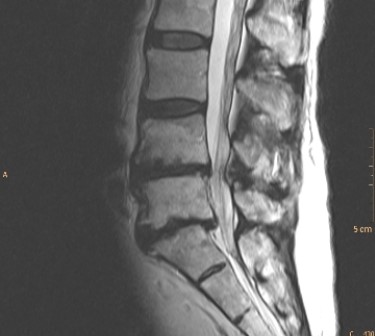   The image shows that this patient has: A)  anterolisthesis of the sacrum. B)  retrolisthesis of L5 in relation to the sacrum. C)  bamboo spine. D)  sacral fracture.