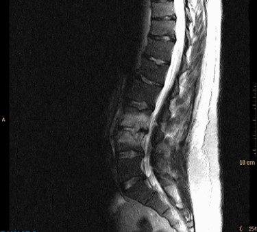   In a patient with back pain and fever, this fat suppressed T2-weighted MRI would suggest: A)  degenerative disk disease. B)  metastatic disease to the spine. C)  spondylolysis. D)  diskitis/osteomyelitis.