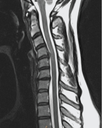   Your diagnosis based on the image shown is: A)  C4/C5 disk herniation. B)  dens fracture. C)  metastatic disease of the spine. D)  soft tissue neck injury.