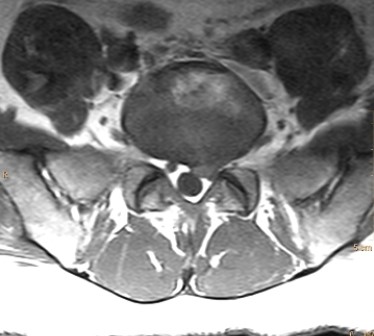   What would be your diagnosis based on the image of this patient? A)  The patient has disk herniation with nerve compression. B)  The patient has left L5/S1 facet joint osteoarthritis. C)  The patient has bilateral L5 pedicle fractures. D)  The patient has cauda equina impingement syndrome.