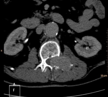   The CT shown is from a patient who presented with sciatica. Your diagnosis is most likely: A)  aortic aneurysm. B)  tumor in a pedicle. C)  herniated disk. D)  spina bifida.