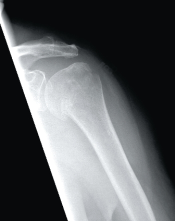 <strong>  This image depicts a patient with:</strong> A) a Salter-Harris fracture. B) a normal proximal humerus. C) an anatomic neck fracture of the humerus. D) a surgical neck fracture of the humerus. <div style=padding-top: 35px> 