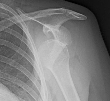   The patient depicted in the image has: A)  an anterior shoulder dislocation. B)  a normal shoulder in complete adduction. C)  a separated shoulder. D)  a fracture of the proximal humeral shaft.