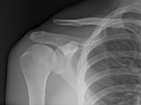   The patient in this image has: A)  a dislocated shoulder. B)  an AC joint separation. C)  a Bankart lesion. D)  a winged scapula.