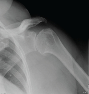   The patient in this image has: A)  glenohumeral joint osteoarthritis. B)  dislocated shoulder. C)  separated shoulder. D)  Bankart lesion.