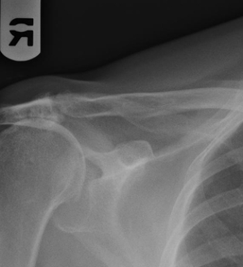   This image from a PA chest radiograph shows the incidental finding of: A)  chronic AC joint separation. B)  old nonunited Bankart fracture. C)  a chronic full-thickness supraspinatus tear. D)  blastic metastatic bone lesions.