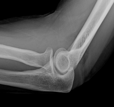 <strong>  Lateral elbow radiograph after trauma; other radiographs show no fracture. Your diagnosis is:</strong> A) occult intra-articular fracture. B) dislocated elbow. C) normal elbow. D) torn distal biceps tendon tour. <div style=padding-top: 35px> 