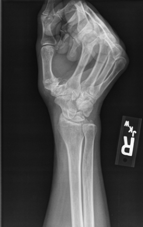   The patient in this image has: A)  a boxer's fracture. B)  degenerative joint disease of the first carpometacarpal joint. C)  a fractured scaphoid. D)  a spiral second metacarpal fracture.