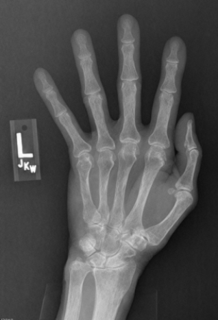   The image shows a patient with: A)  acute onset of hand pain. B)  a positive rheumatoid arthritis (RA)  titer. C)  carpal tunnel syndrome. D)  history of multiple prior hand injuries.