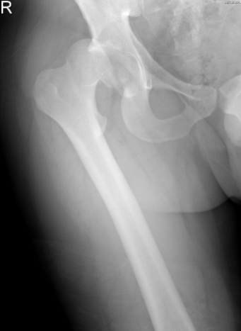   The patient in this image has: A)  hip joint degenerative joint disease. B)  hip joint dislocation. C)  fractured femoral neck. D)  femoral neck osteophyte.