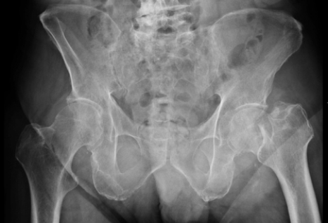   Based on the image, what condition/injury does this patient have? A)  A left femoral neck fracture B)  Right hip degenerative joint disease C)  Lytic bone disease D)  Fracture of the right ilium