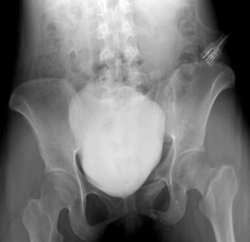   The skeletal findings in this patient with a distended bladder (opacified after contrast-enhanced CT)  include: A)  right hip dislocation. B)  left pubic rami fractures. C)  right hip joint degenerative joint disease. D)  right femoral neck fracture.