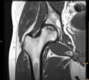   What can you tell about the patient in the MR image? A)  The patient has been on high-dose steroids for a severe rash. B)  The patient is an oncology patient with new onset of hip pain. C)  The patient has hip pain associated with high fever and leukocytosis. D)  The patient has a normal hip; symptoms in the hip are secondary to lumbar disk disease.
