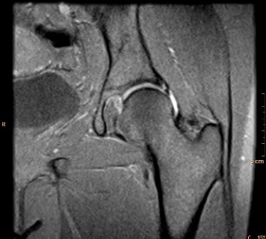   This MR arthrogram depicts a patient with: A)  a normal physical exam of the hip. B)  systemic arthritis. C)  pain and sensation of clicking in the joint. D)  injury suffered while playing shuffleboard.