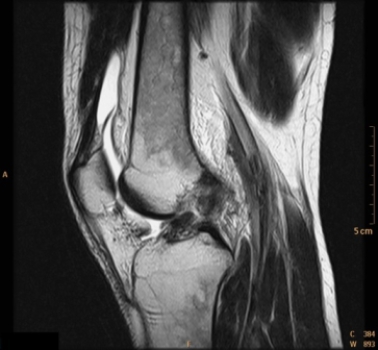   The patient in this image has: A)  knee joint rheumatoid arthritis. B)  a skiing injury. C)  knee joint osteoarthritis. D)  puncture wound to the knee joint.