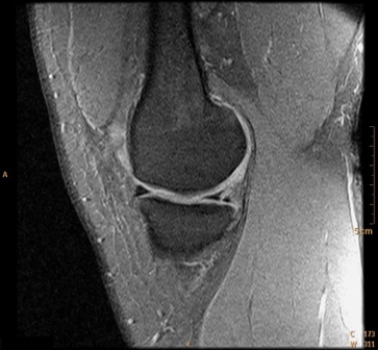   The MR image shows a patient with a: A)  normal knee. B)  meniscus tear. C)  patella alta. D)  popliteal venous thrombosis.