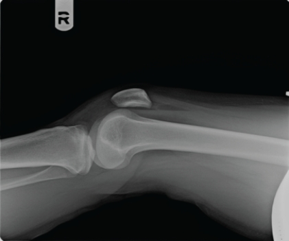   Radiographs on this patient, including the cross-table lateral shown here, revealed no visible fracture. How will the patient be managed? A)  Because no fracture is shown, the patient will be told that walking is safe, NSAIDs will be prescribed, and the patient will be referred to physical therapy. B)  Because of the lipohemarthrosis, the patient will be kept on non-weight-bearing and will have an urgent CT or MRI. C)  Radiographic findings above suggest medial meniscus tear. The patient will be scheduled for MRI next week and will be scheduled to see an orthopedic surgeon whenever convenient. D)  Physical examination was unremarkable and the patient was told to go back to work.