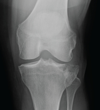  The patient in this image: A)  has a normal knee. B)  has a Segond fracture. C)  is a patient with Osgood-Schlatter disease. D)  has a tibial plateau fracture.
