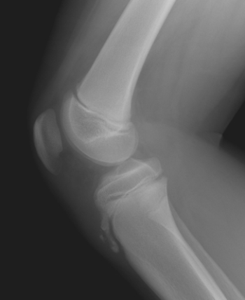   Based on the image of this pediatric patient, what can you tell this patient has? A)  Clinical findings of Osgood-Schlatter disease B)  Acute twisting injury of the knee C)  Tenderness of the quadriceps tendon D)  Popliteal fossa mass
