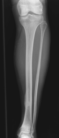   The patient in this image has which of the following injuries/conditions? A)  Tibial osteosarcoma B)  Lateral malleolar fracture C)  A healing tibial stress fracture D)  Fibula osteomyelitis
