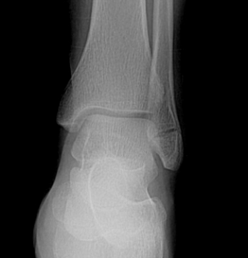   The patient in this image has suffered what type of injury? A)  A lateral malleolar fracture; stable ankle mortise B)  A lateral malleolar fracture with widening of the ankle mortise C)  A talar dome osteochondral lesion D)  Stress fracture of the first metatarsal