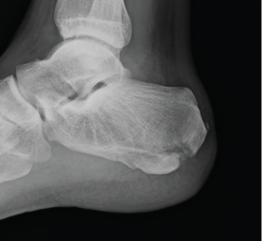   What can you tell about this patient whose lateral calcaneus radiograph is shown? A)  The patient is a long-distance runner with chronic heel pain. B)  The patient has lost the ability to plantar flex at the ankle. C)  The patient has cancer with new onset of foot pain. D)  This patient landed on his feet from a 12-foot fall and also has back pain.