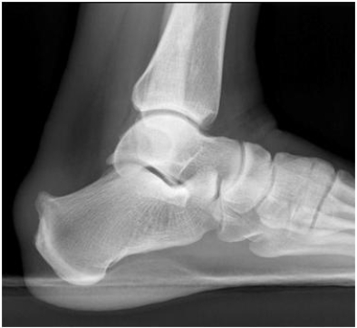 <strong>  The patient in the following image has:</strong> A) a normal foot. B) a Haglund's deformity. C) a Lisfranc fracture. D) plantar fasciitis. <div style=padding-top: 35px> 