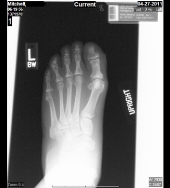   What specific injury/deformity does the patient in this image suffer from? A)  Rheumatoid arthritis (RA)  of the first tarso-metatarsal joint B)  Lisfranc fracture C)  Bunion deformity D)  Haglund's deformity