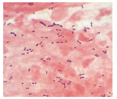 An 83-year-old who still lives in her own home has developed pneumonia following influenza. The Gram stain of her sputa is shown. What is the most likely agent?   A) Chlamydophila pneumoniae B) Influenza virus C) Klebsiella pneumoniae D) Mycoplasma pneumoniae E) Staphylococcus aureus F) Streptococcus pneumoniae