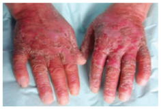 <strong>A 60-year-old chronic smoker and alcoholic man Suffering from odynophagia, insomnia, epigastric Discomfort, and recurrent diarrhea presented to The outpatient department. Clinical examination Revealed memory disorientation, stomatitis, glossitis, esophagitis, and exfoliative dermatitis with some Vesicles on erythematous bases on photoexposed Sites such as his hands shown in the attached image. These signs and symptoms are most likely the result Of a deficiency in which of the following vitamins? </strong> A) biotin B) cobalamin C) niacin D) riboflavin E) thiamin
