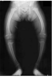<strong>The attached radiograph shows the typical bowed legs of an infant suffering from a deficiency in which of the following vitamins? </strong> A) A B) C C) D D) E E) K