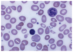 <strong>A smear of your patients' blood is shown in the following picture demonstrating that the person suffers from a form of anemia. A deficiency in which of the following vitamins would lead to the anemia shown in the slide? </strong> A) B<sub>1</sub> (thiamin) B) B<sub>6</sub> (pyridoxal phosphate) C) B<sub>12</sub> (cobalamin) D) biotin E) K