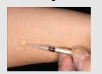 <strong>This picture represent which Route? </strong> A) Intradermal to check allergy to penicillin B) Intravenous to check allergy to penicillin C) Intramuscular to check allergy to penicillin