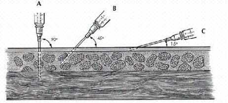 Using the illustration below, select the proper angle for the nurse to use in administering a subcutaneous injection for the average adult.   A)  90° B)  45° C)  15° D)  Any of the above