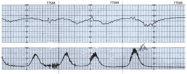 Client is at 38 weeks' gestation, gravida 1, para 0, vaginal exam-4 cm, 100% effaced, +1 station vertex. What is the most likely intervention for this fetal heart rate pattern?    A)  Continue oxytocin (Pitocin)  infusion.  B)  Contact the anesthesia department for epidural administration.  C)  Change maternal position.  D)  Administer Narcan to client and prepare for immediate vaginal delivery.
