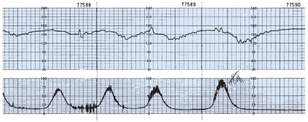 The nurse is monitoring a client in labor and notes this fetal heart rate pattern on the electronic fetal monitoring strip (see figure) . Which is the most appropriate nursing action?    A)  Administer oxygen with a face mask at 8 to 10 L/min.  B)  Reposition the fetal monitor ultrasound transducer.  C)  Assist the client to the bathroom to empty her bladder .  D)  Continue to monitor the client and fetal heart rate patterns.