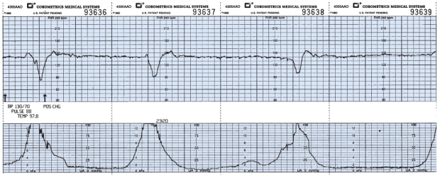 The nurse is monitoring a client in labor and notes this fetal heart rate pattern on the electronic fetal monitoring strip (see figure) . Which is the most appropriate nursing action?    A)  Decrease the rate of the IV fluids.  B)  Document the fetal heart rate pattern.  C)  Explain to the client that the pattern is reassuring.  D)  Perform a vaginal exam to detect a prolapsed cord.
