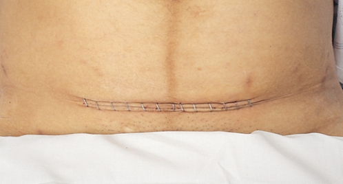 The nurse is performing a postpartum assessment on a client and concludes with the assessment depicted in the figure. Which is the rationale for performing the depicted assessment?    A)  Check for edema.  B)  Check for range of motion.  C)  Check for adequate reflexes.  D)  Check for deep vein thrombosis.