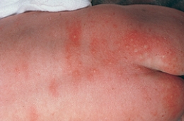 The nurse is assessing a newborn and notes a nevus flammeus birthmark. Which of the following figures depicts this birthmark?  A)     B)     C)     D)   